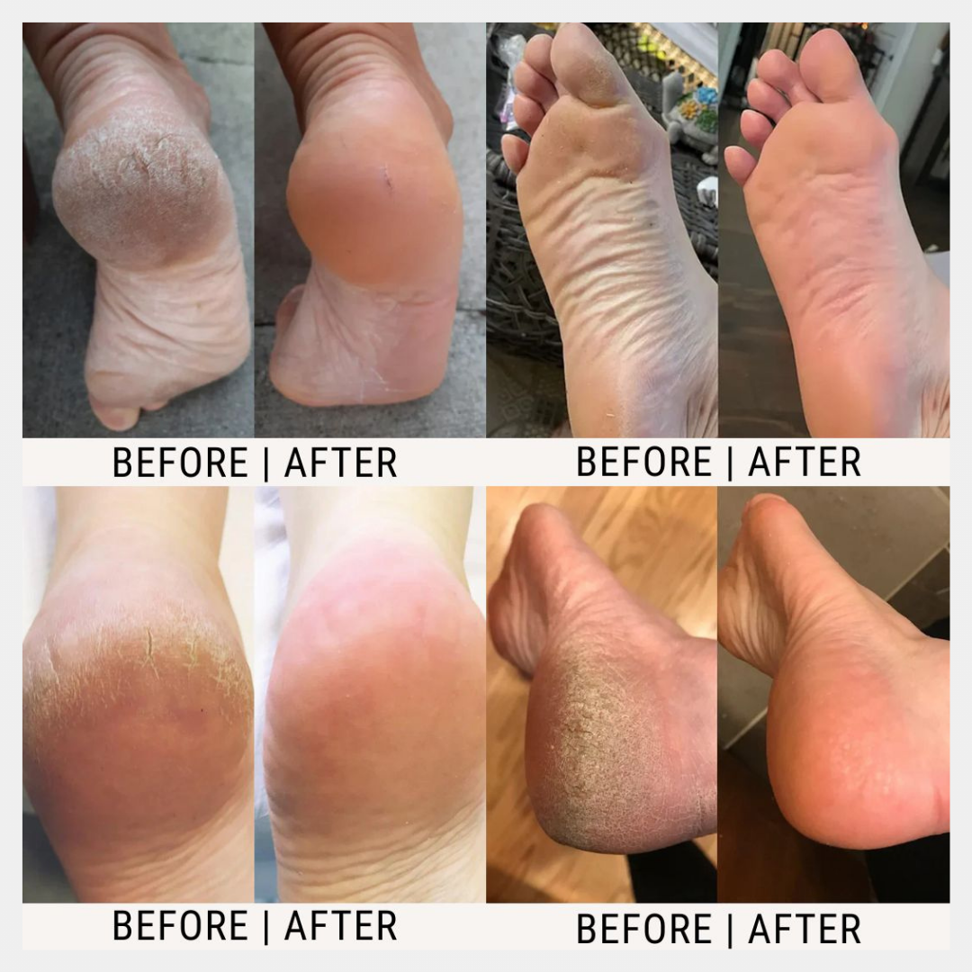 NovaCare™ Urea Foot-Cream