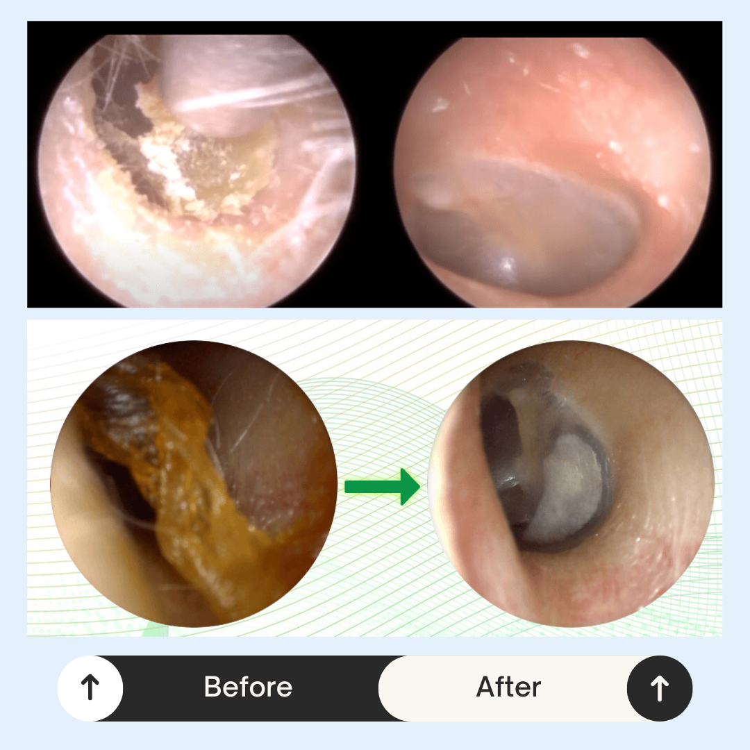 SonicClear Earwax Remover