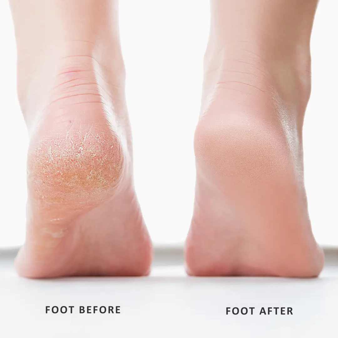 PediPerfect Foot Callus Remover