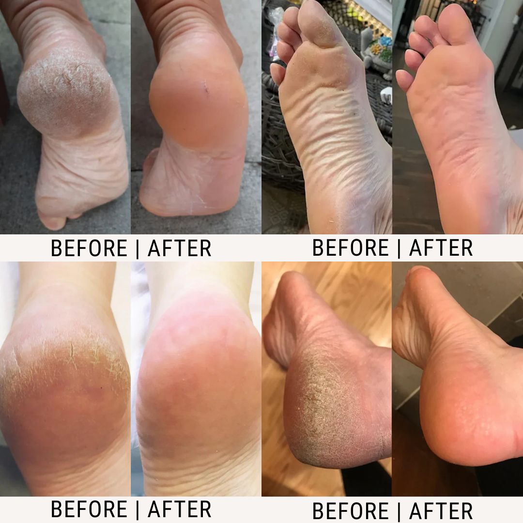NovaCare™ Urea Foot Cream